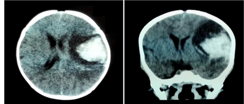 hemorragia intracraneal